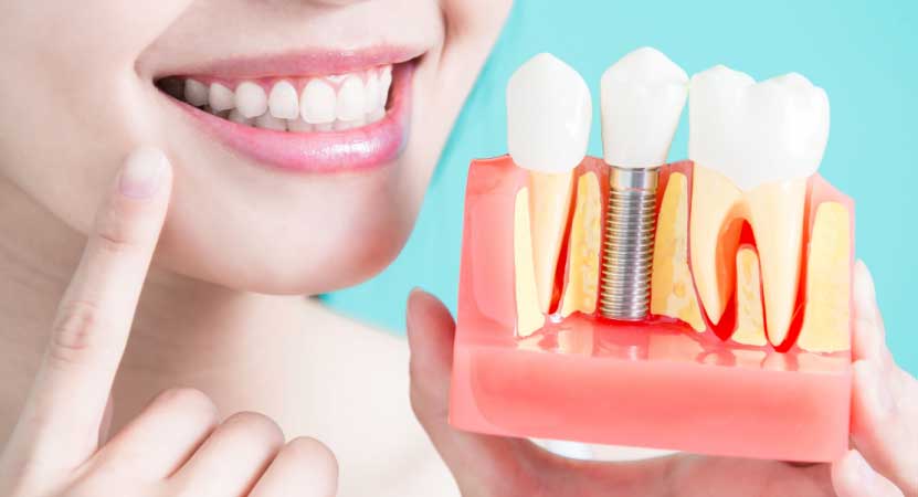 Implante dentário em Curitiba - Odontologia Curitiba