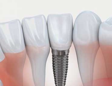 Próteses sobre implantes - Odontologia Curitiba